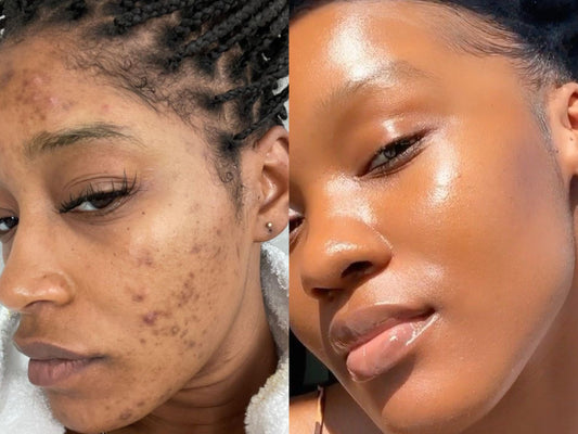 Say Goodbye to Hyperpigmentation with Just One Product